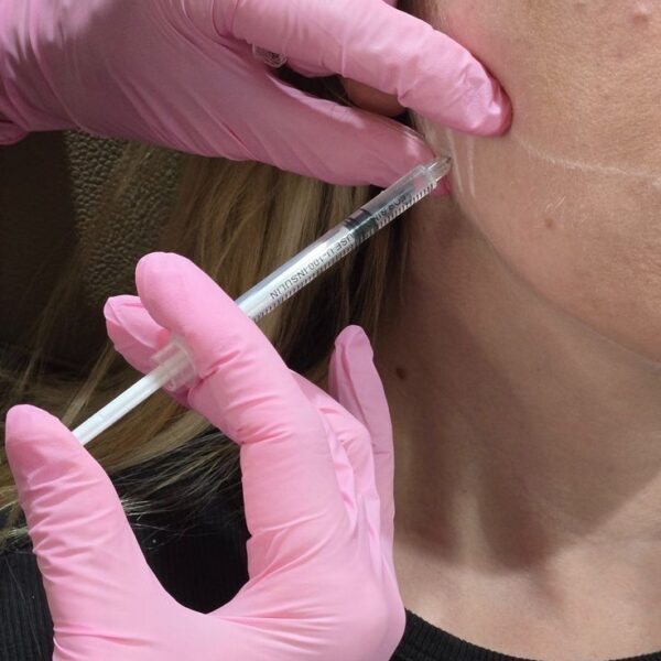 DERMAL FILLER 1ml