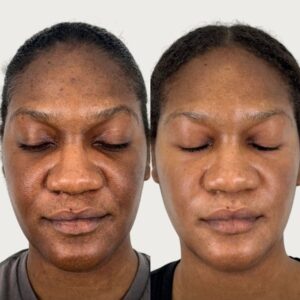 Chemical Peel